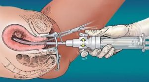 Употребление Регулона после замершей беременности