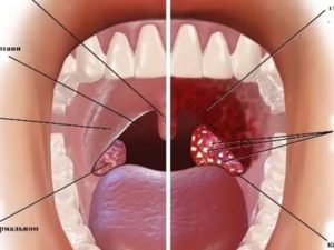 В горле странная шишка, не мешает, хронический тонзиллит