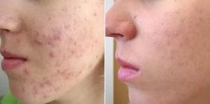 Аутогемотерапия при месячных