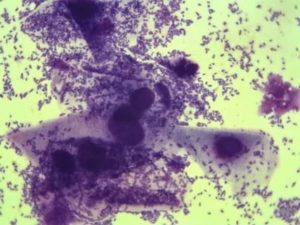 В мазке коккобациллярная флора