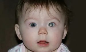 Разные зрачки цветом у ребенка на фото