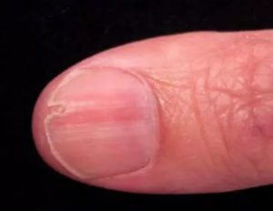 Трещина на ногте у кутикулы