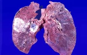 Новобразование в легких
