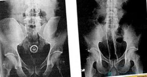 Боль, ощущение давления и инородного тела во влагалище