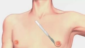 Камушки в сосках