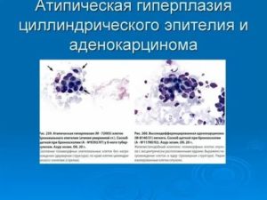 Результат кольпоскопии, пролиферация железистого эпителия