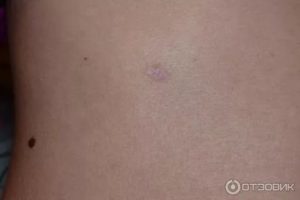 Родинка удалена не до конца