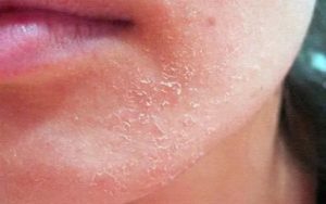 Зуд кожи, шелушение