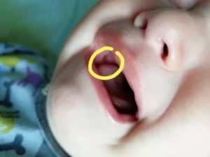 Красные точки во рту на щеке