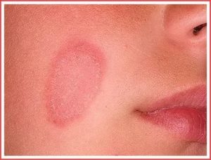 Красное пятно на коже, долго не проходит