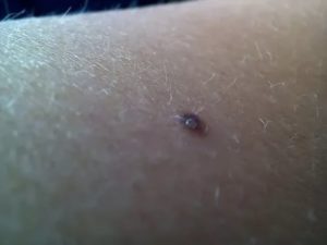 Образование на коже словно запекшая кровь