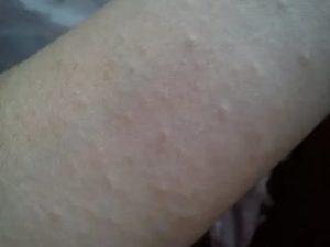 Сыпь на руках и ногах без зуда