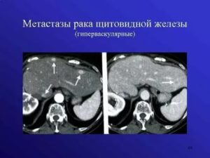 Гиперваскулярные очаги