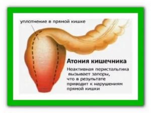 Атония прямой кишки