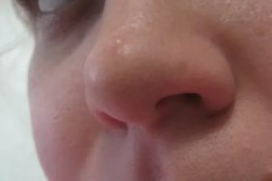 Опухло крыло носа