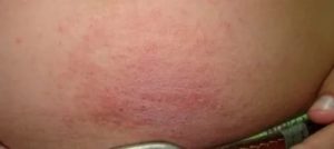 Нейродермит при беременности