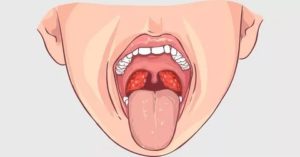 Хламидийный фарингит