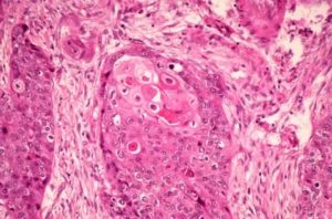 Очаговая метаплазия