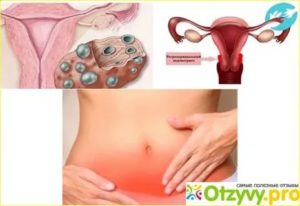 Тянет и колет в левом яичнике после овуляции