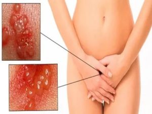 Сильное раздражение у входа во влагалище