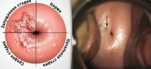 Установка спирали после прижигания эрозии