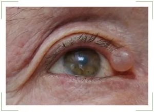 Пузырик в уголке глаза