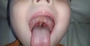 Красные точки во рту на щеке