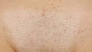 Зуд в области бикини