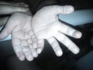 Зимой у дочери облазит кожа на ладошках и пальчиках