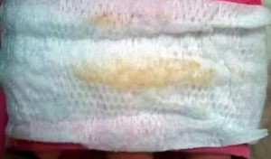 Светло-бежевые выделения от утрожестана