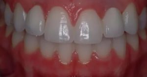 Аллергия на штифты