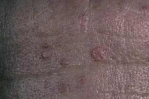 Сальные железы на поверхности полового члена