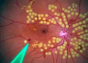 Боль и дискомфорт в глазу после лазерной коагуляции