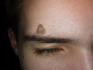 Родинка на брови