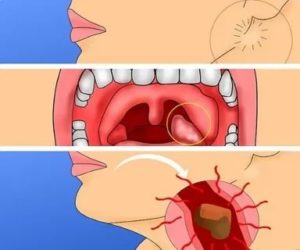 Горло не болит, а глотать больно