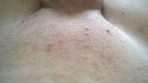 Прыщ между большой и малой половой губой