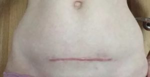 Тянет и болит шов после операции