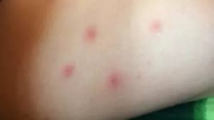 Сыпь, похожая на ветрянку