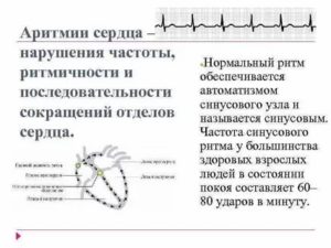 Сбой сердечного ритма два удара с 2-х секундной паузой минуту