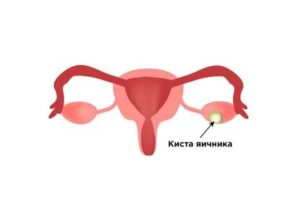 Киста левого яичника аденомиоз