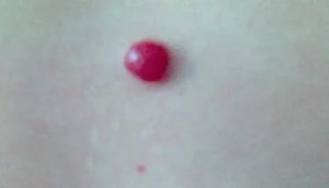 Образование на коже словно запекшая кровь