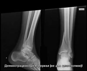 Перелом эпифиза большеберцовой кости