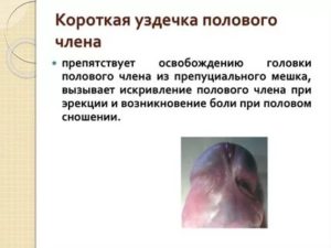 Опухла левая половина головик полового члена