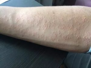 Зуд на внутренней стороне предплечья