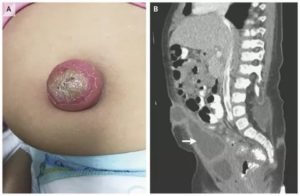 Камушки в сосках