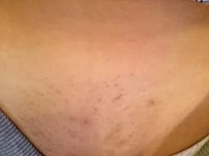 Зуд в области бикини