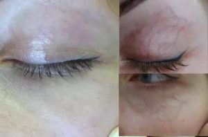 Под кожей века вена?