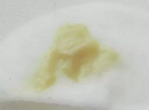 Желтые выделения после прижигания шейки матки