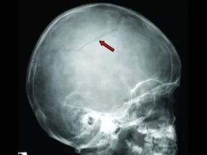 Рентген головы ребенка