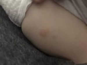 Розовые пятна на попе у ребёнка